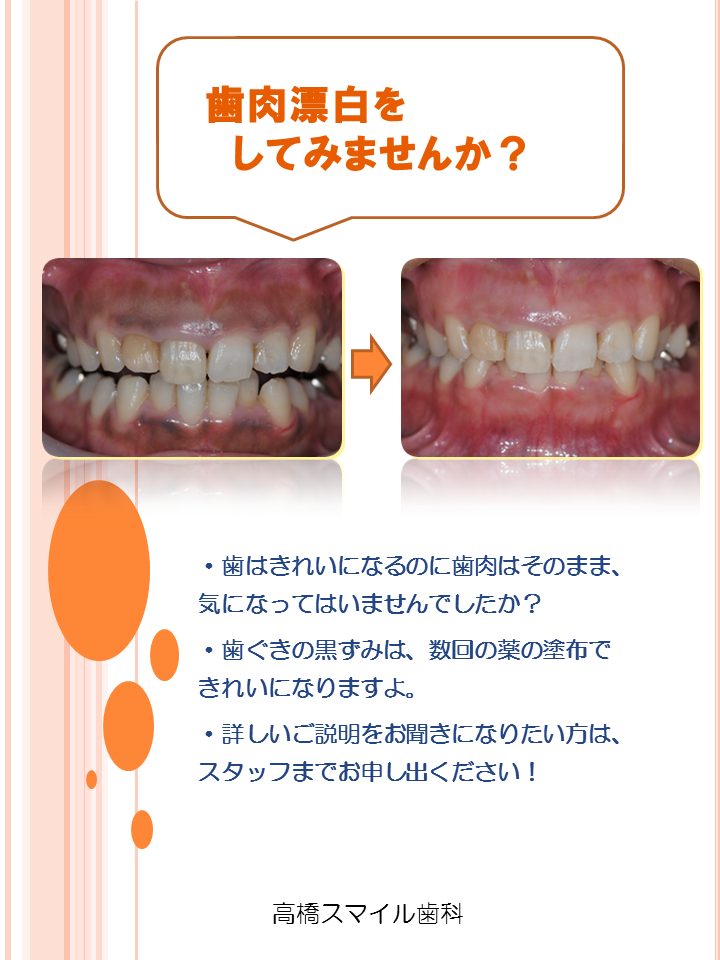 歯肉漂白をしてみませんか？