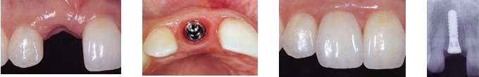 インプラント治療のご紹介